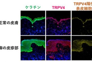 アイキャッチ-温度感受性受容体チャネルTRPV4が乾癬の病態に重要な役割を果たすことを解明_R050607